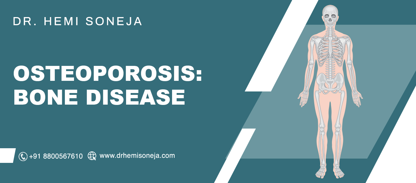 Osteoporosis: Symptoms, Causes, Diagnosis